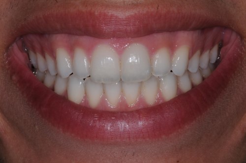 The longterm outcome after soft surgeries 